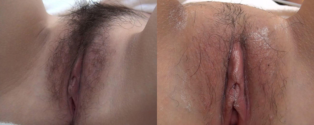 如何实现人造白虎神器  情侣现场实操示范如何清理私处阴毛 黑森林褪去展现女优同款蜜穴 